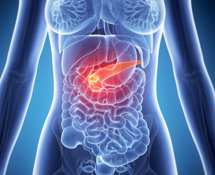 Casos de cáncer en páncreas relacionados con tabaquismo, diabetes y obesidad