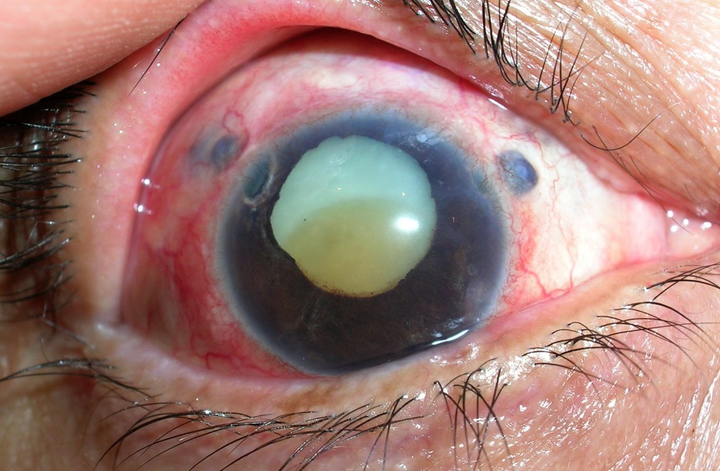 El glaucoma, el principal enemigo de los ojos; puede causar ceguera irreversible