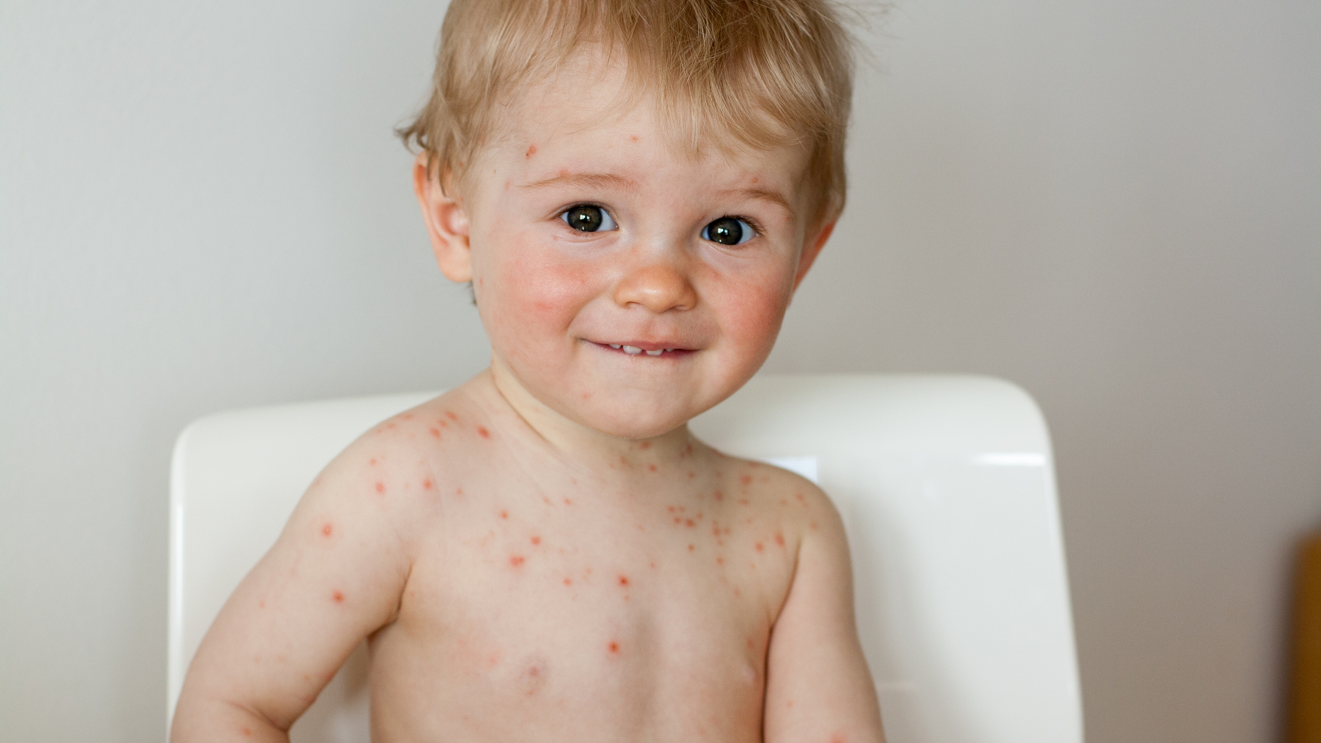 La varicela, infección que afecta la población infantil. Foto: Internet.