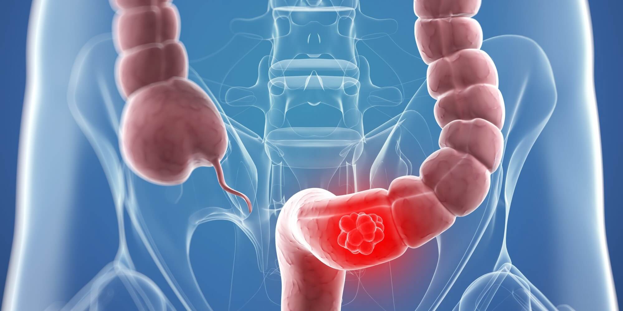 Un estudio revela que una proteína ayuda a detener el cáncer de colón. Foto: Internet.