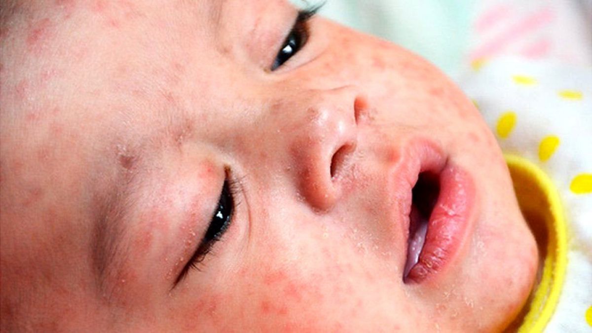 Emiten recomendaciones ante brote global de sarampión. Foto: Internet.