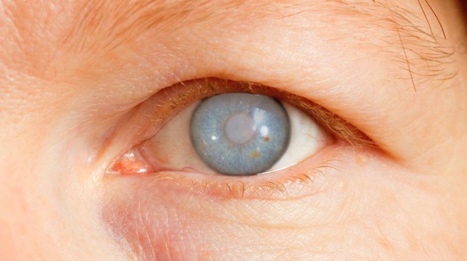 Expertos identifican proteínas que ayudarán al diagnóstico temprano del glaucoma