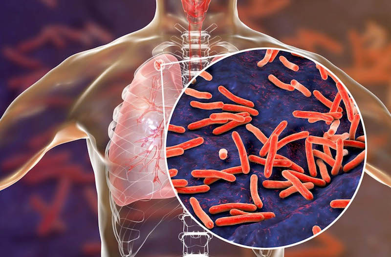 Tuberculisis, enfermedad antigua, pero sin erradicarse.