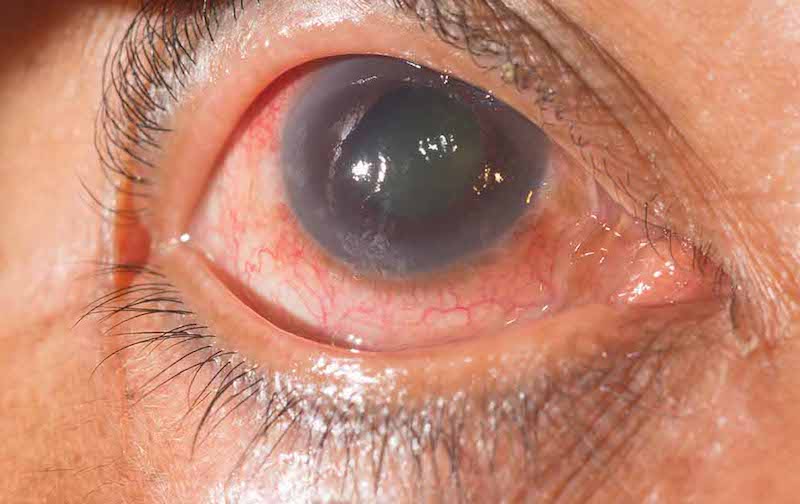 7 factores de riesgo que pueden desarrollar glaucoma.