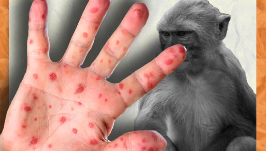 Aumentan a 60 los casos de Viruela del Mono en México; emiten segundo aviso epidemiológico