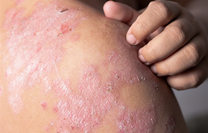 Dermatitis, estos son los factores de riesgo y recomendaciones