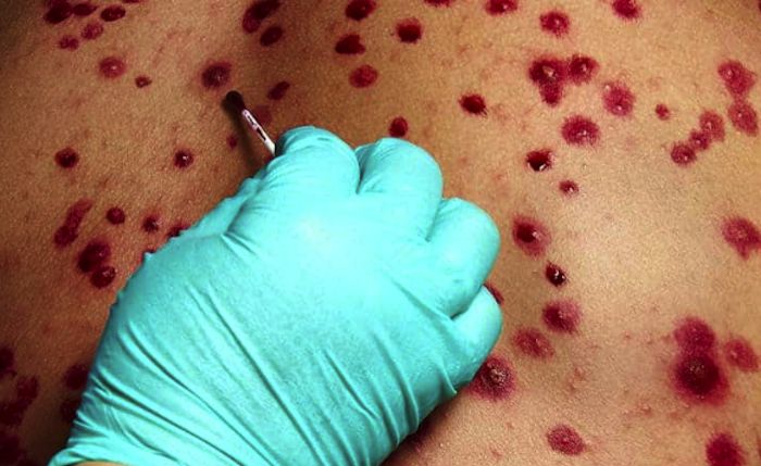 Se elevan a 27 los casos de viruela símica en Querétaro