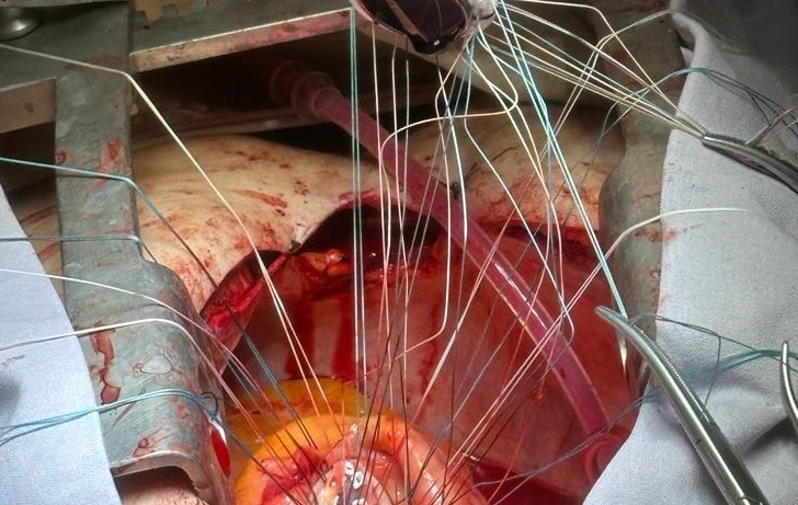 Equipo médico de Querétaro realiza con éxito cirugía a corazón abierto.