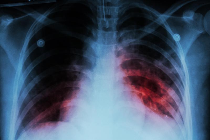 La tuberculosis, enfermedad prevenible y curable que mató a 35 mil personas.
