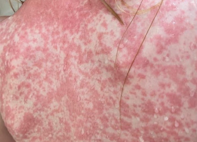 Confirman siete casos de sarampión en Querétaro