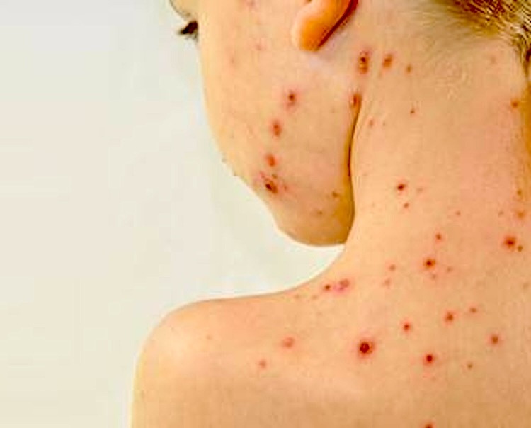 Suben a 12 los casos confirmados de sarampión en Querétaro durante 2026